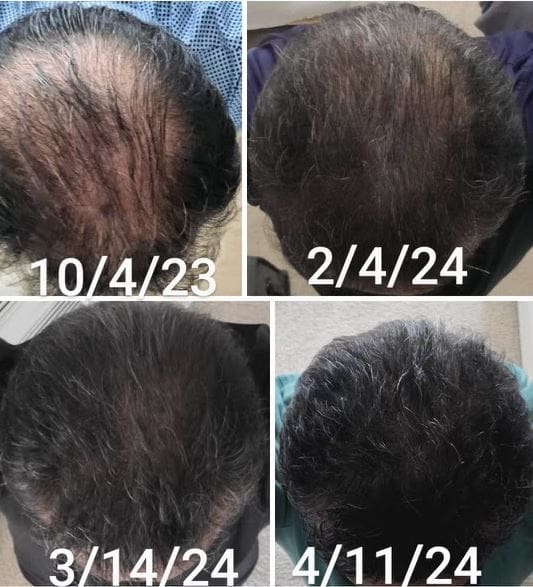 Hair restoration progress photos with PRP therapy.